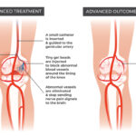 Genicular Artery Embolization