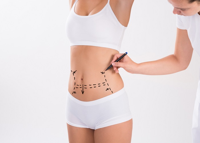 Liposuction in Islamabad: What You Need to Know