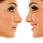 Rhinoplasty in Riyadh