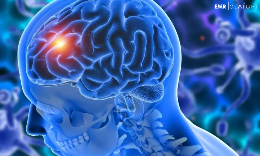 Global Glioblastoma Multiforme Treatment Market