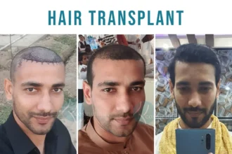 best hair transplant in lahore